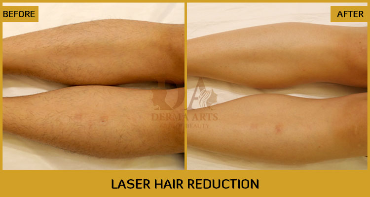 Female Laser Hair Removal Before & After