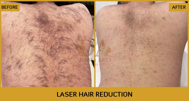 Male Laser Hair Removal Before & After