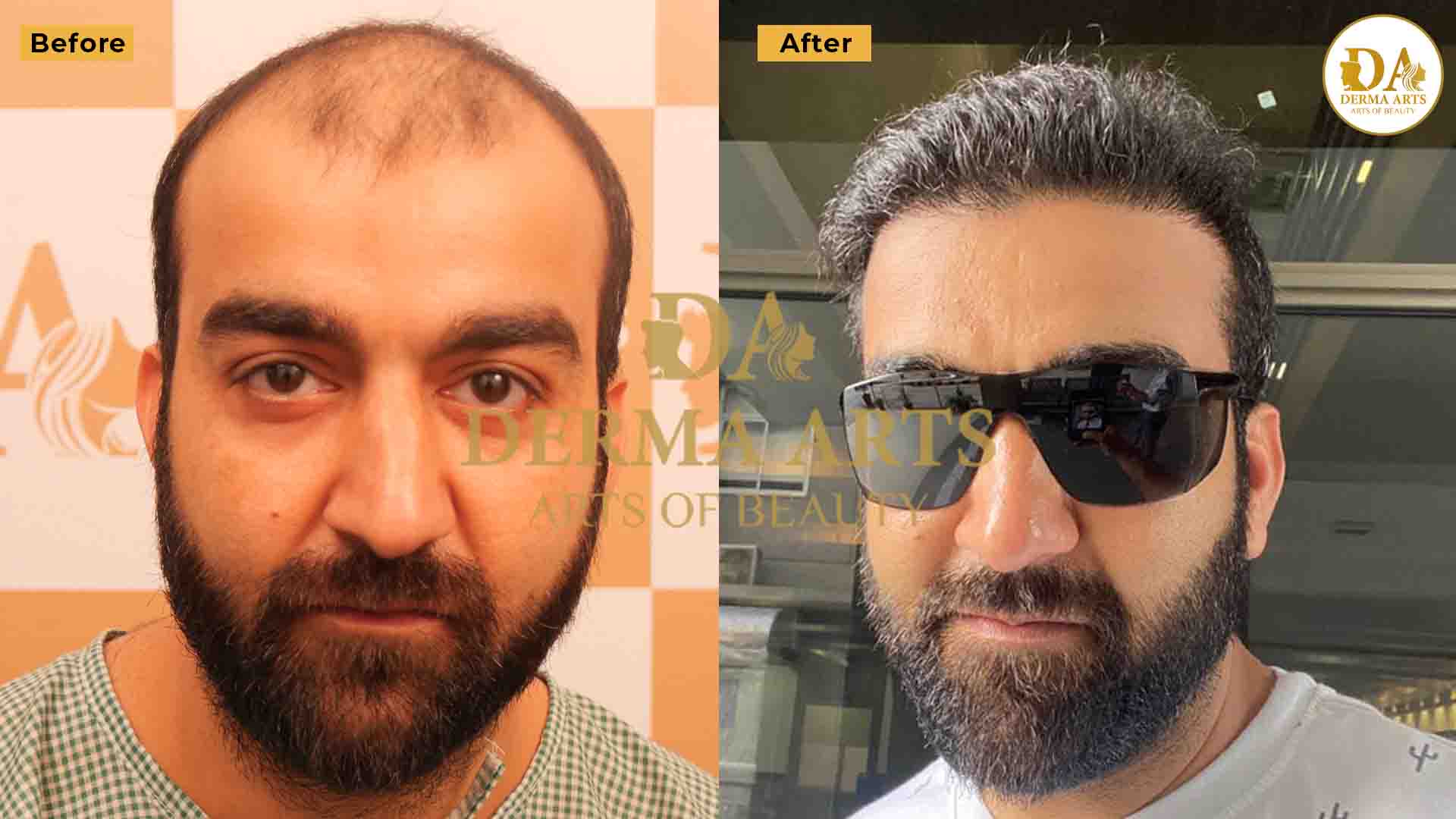 Delhi hair transplant before and after