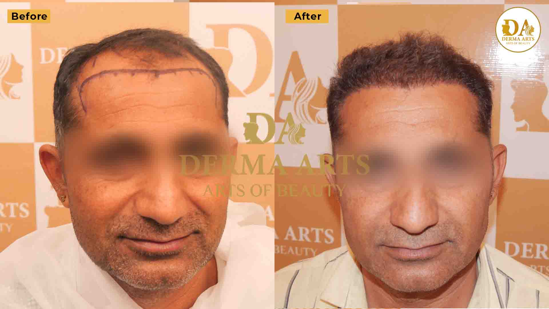 before and after hair transplant delhi
