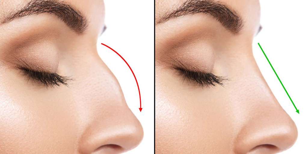 Best Rhinoplasty (Nose Surgery) in South Delhi