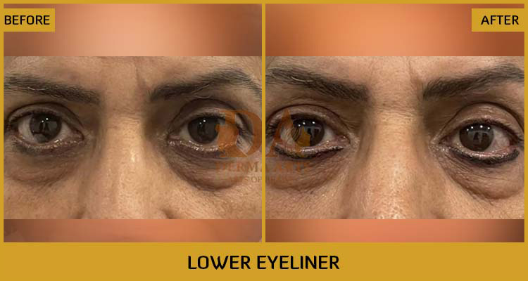 Lower Eyeliner Before & After