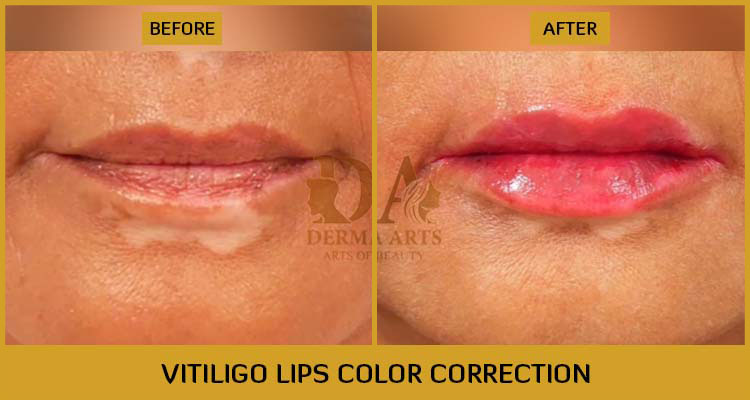 Vitiligo Lips Color Correction Before & After