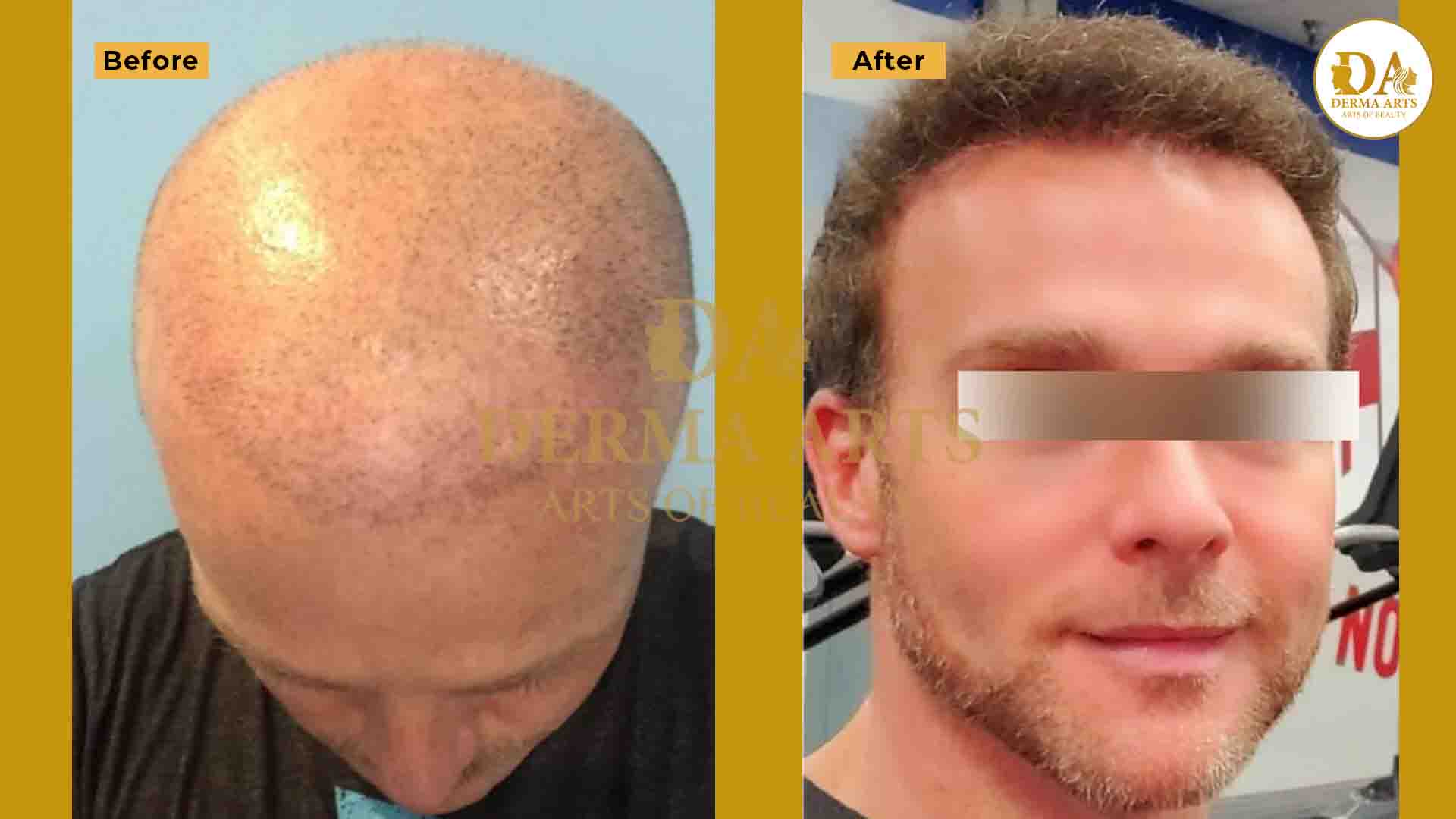 Results showing before and after hair transplant treatment
