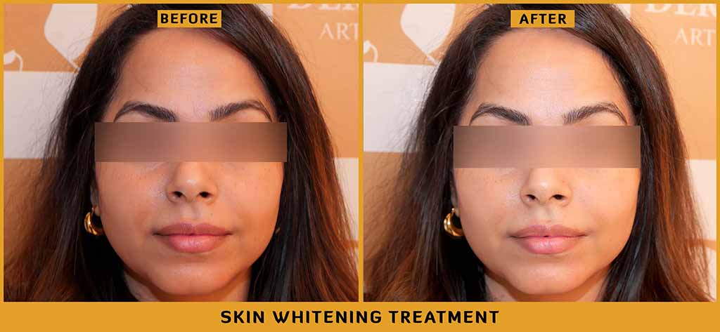 Skin Whitening Treatment in Delhi Results