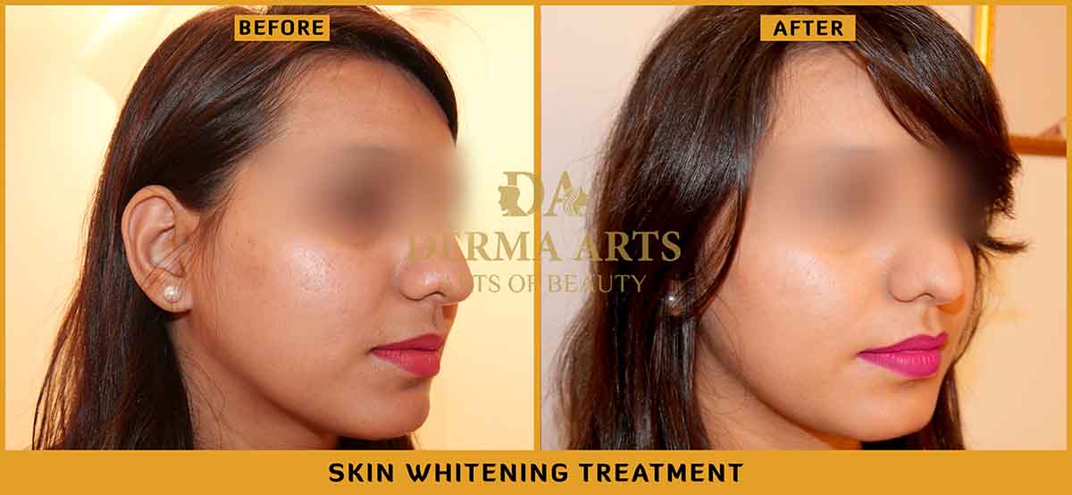 Skin Whitening Treatment Results before and after