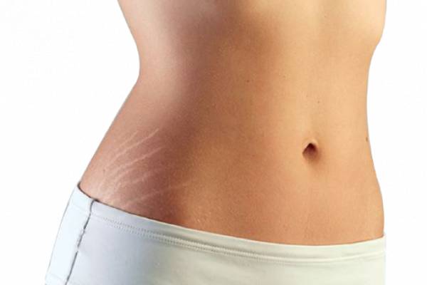 Best Stretch Marks Treatments in Delhi