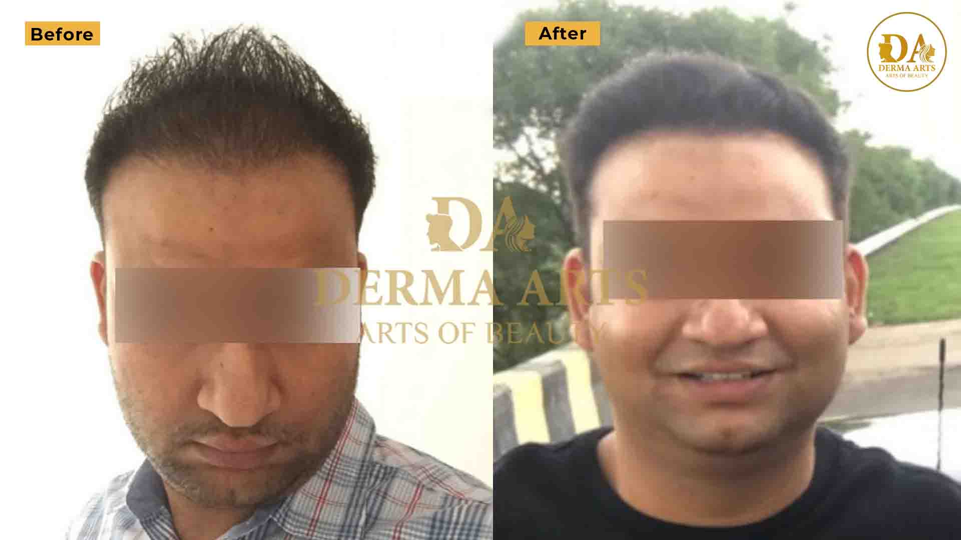 hair transplant Delhi results