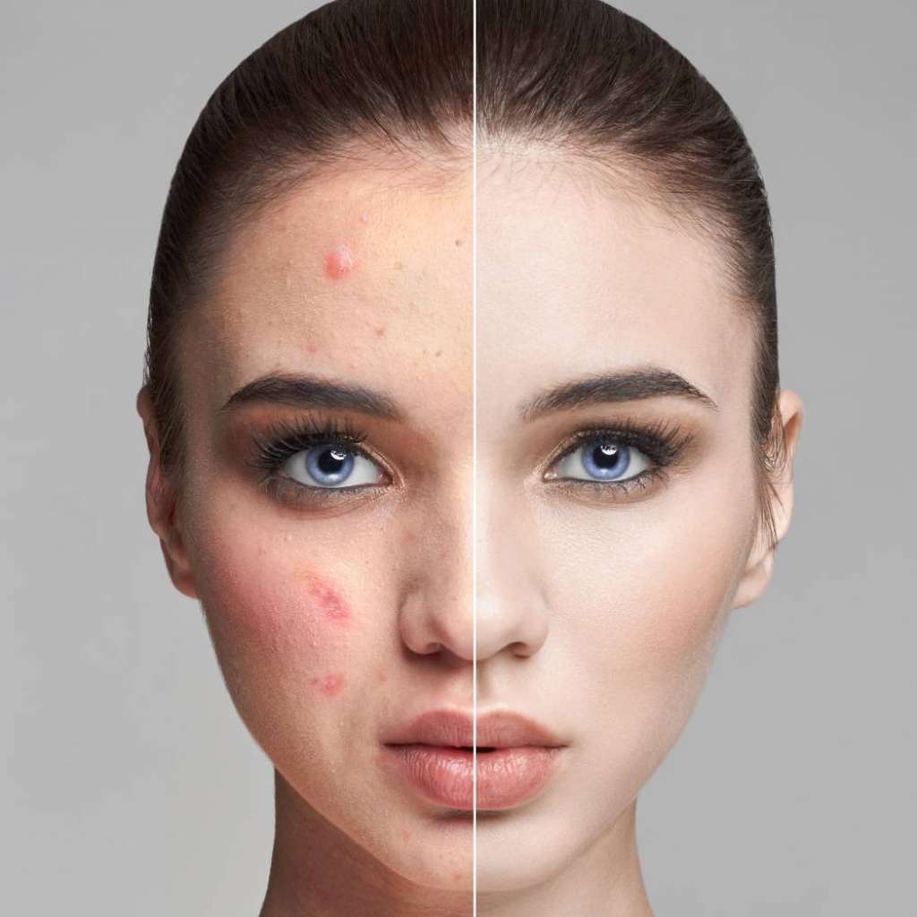 How To Get Rid Of Acne Scars And What Products To Use
