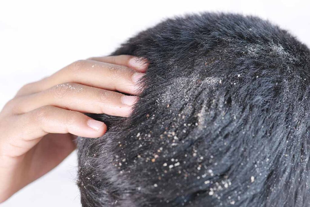 Dandruff and Hair Loss: Are they linked?