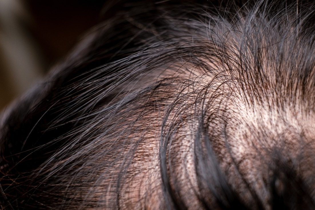 hair loss caused by vitamin deficiency