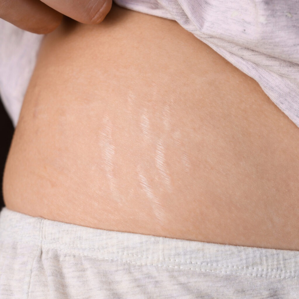 How to Remove Pregnancy Stretch Marks?