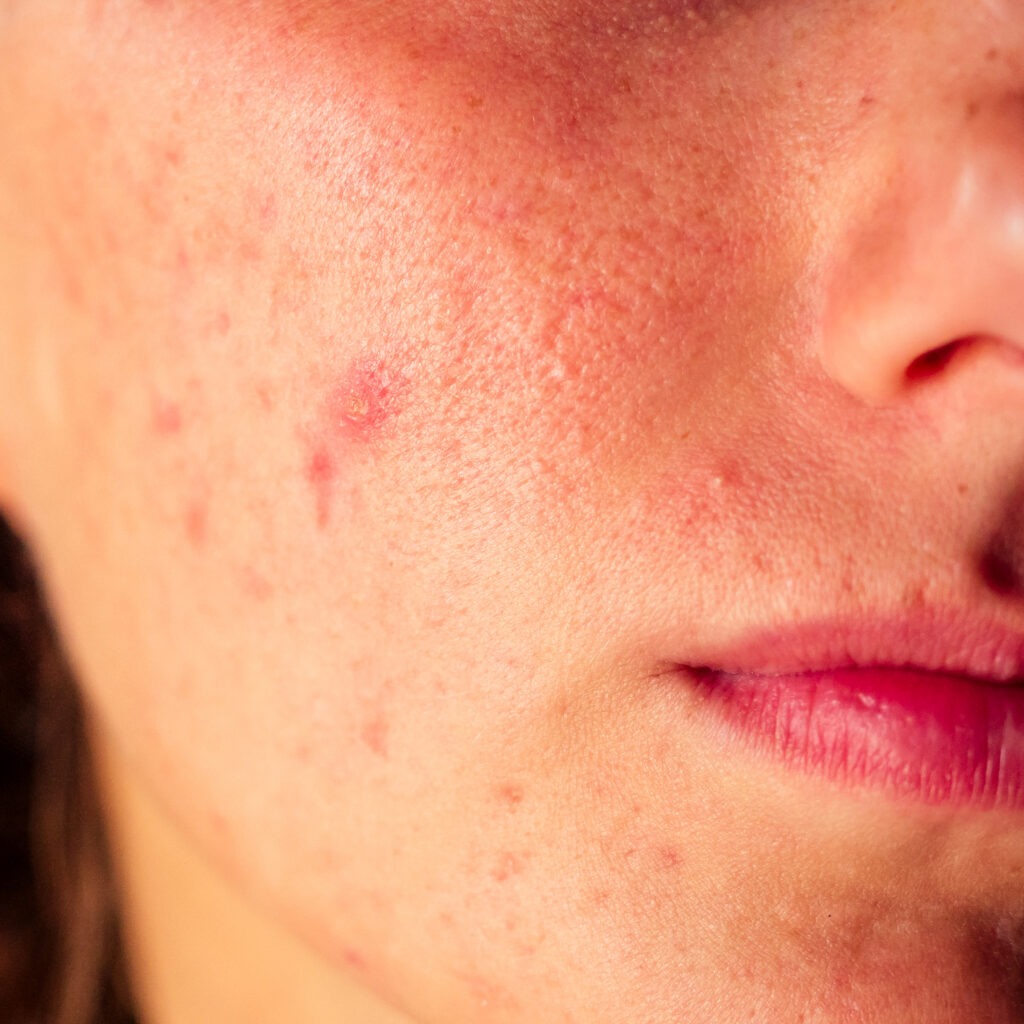 Which Treatment is Best for Acne Scars?