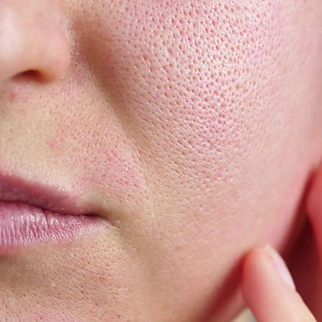 How To Permanently Close Open Pores On The Face