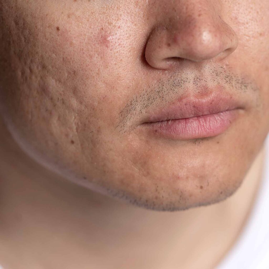 How Long Does It Take To Get Rid Of Acne Scar?